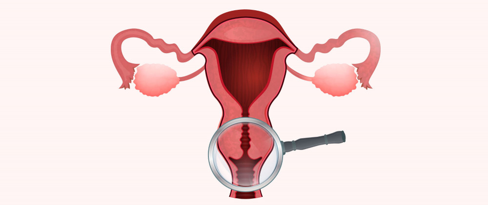 Die Zervix aka der Gebärmutterhals beschreibt den unteren Teil der Gebärmutter und ragt mit dem Muttermund in den oberen Teil der Vagina hinein.
