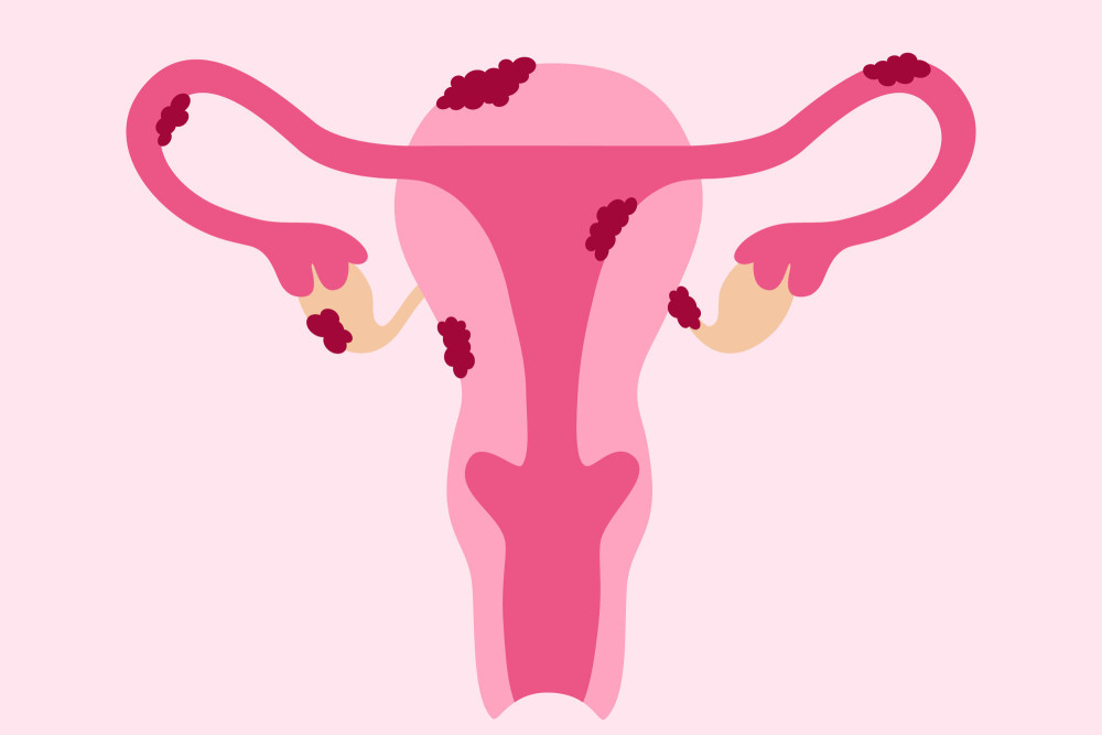 So oder ähnlich kann eine Endometriose-Erkrankung aussehen.