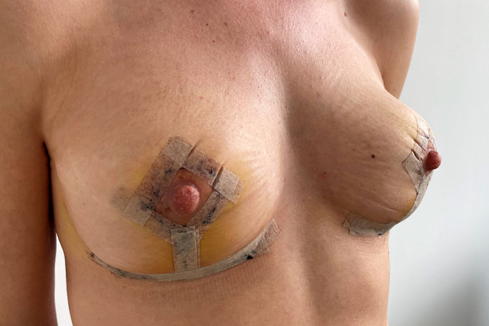 Eine Woche nach der OP